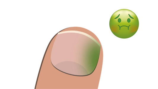 Cartoon-style illustration depicting Green Nail Syndrome, highlighting the importance of nail health.